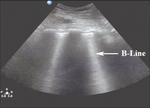 Pneumothorax_Images Normales3.jpg