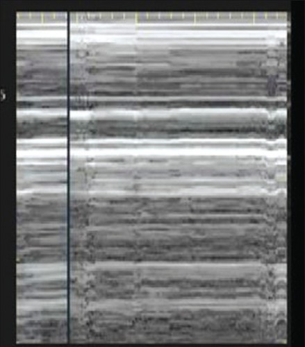 Pneumothorax_Images PasNormales1.jpg