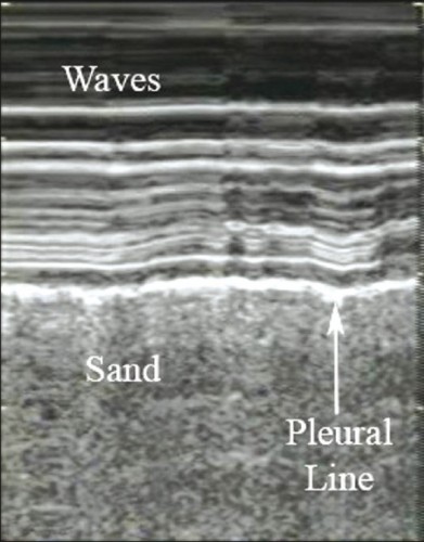 Pneumothorax_Images Normales2.jpg