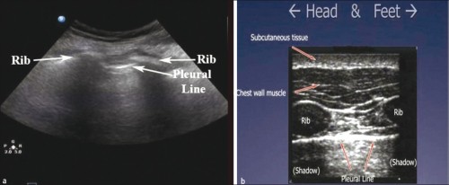 Pneumothorax_Images Noramales1.jpg