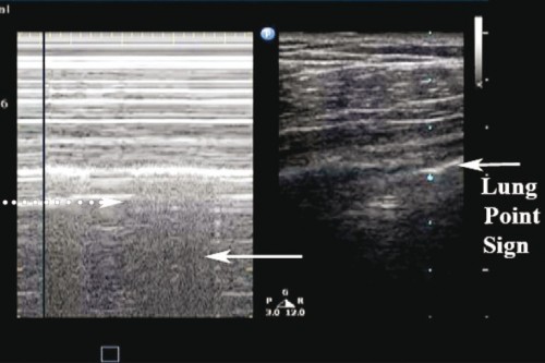 Pneumothorax_Images PasNormales3.jpg