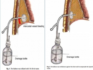 Foley Thorax.jpg